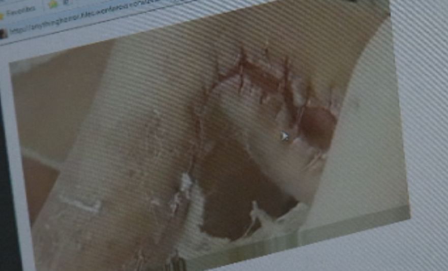 LoVecchio points out an image that shows a Krokodil user's leg.